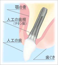 インプラント